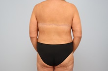 Mommy Makeover After Photo by Keith Neaman, MD; ,  - Case 50211