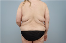 Mommy Makeover Before Photo by Keith Neaman, MD; ,  - Case 50211