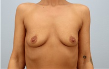 Breast Augmentation Before Photo by Keith Neaman, MD; ,  - Case 50212 Breast Augmentation Before Photo by Keith Neaman, MD; ,  - Case 50212