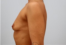 Breast Augmentation Before Photo by Keith Neaman, MD; ,  - Case 50212