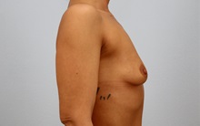 Breast Augmentation Before Photo by Keith Neaman, MD; ,  - Case 50212