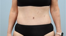 Tummy Tuck After Photo by Keith Neaman, MD; ,  - Case 50213