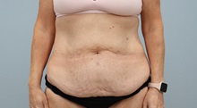 Tummy Tuck Before Photo by Keith Neaman, MD; ,  - Case 50213