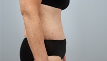 Tummy Tuck After Photo by Keith Neaman, MD; ,  - Case 50213
