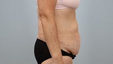 Tummy Tuck Before Photo by Keith Neaman, MD; ,  - Case 50213