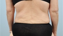 Tummy Tuck After Photo by Keith Neaman, MD; ,  - Case 50213