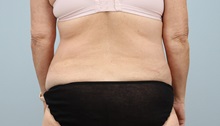 Tummy Tuck Before Photo by Keith Neaman, MD; ,  - Case 50213