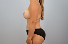 Mommy Makeover After Photo by Keith Neaman, MD; ,  - Case 50224