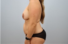 Mommy Makeover Before Photo by Keith Neaman, MD; ,  - Case 50224