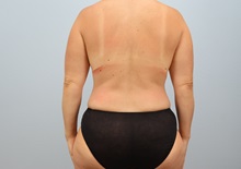 Mommy Makeover After Photo by Keith Neaman, MD; ,  - Case 50224