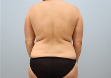 Mommy Makeover Before Photo by Keith Neaman, MD; ,  - Case 50224