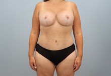 Mommy Makeover After Photo by Keith Neaman, MD; ,  - Case 50241 Mommy Makeover After Photo by Keith Neaman, MD; ,  - Case 50241