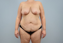 Mommy Makeover Before Photo by Keith Neaman, MD; ,  - Case 50241 Mommy Makeover Before Photo by Keith Neaman, MD; ,  - Case 50241