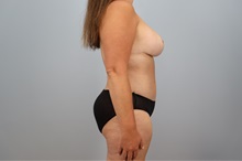 Mommy Makeover After Photo by Keith Neaman, MD; ,  - Case 50241