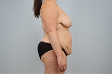 Mommy Makeover Before Photo by Keith Neaman, MD; ,  - Case 50241