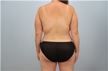 Mommy Makeover After Photo by Keith Neaman, MD; ,  - Case 50241