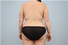 Mommy Makeover Before Photo by Keith Neaman, MD; ,  - Case 50241