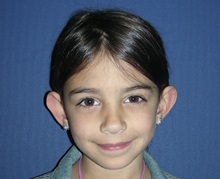 Ear Surgery Before Photo by Rachel Ruotolo, MD; Garden City, NY - Case 29108