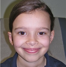 Ear Surgery After Photo by Rachel Ruotolo, MD; Garden City, NY - Case 29109