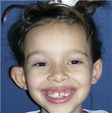 Ear Surgery Before Photo by Rachel Ruotolo, MD; Garden City, NY - Case 29109