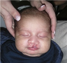 Cleft Lip and Palate Repair Before Photo by Rachel Ruotolo, MD; Garden City, NY - Case 29111