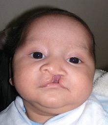 Cleft Lip and Palate Repair Before Photo by Rachel Ruotolo, MD; Garden City, NY - Case 30303