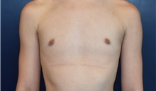 Male Breast Reduction After Photo by Rachel Ruotolo, MD; Garden City, NY - Case 30304