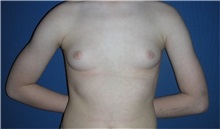 Male Breast Reduction Before Photo by Rachel Ruotolo, MD; Garden City, NY - Case 30304