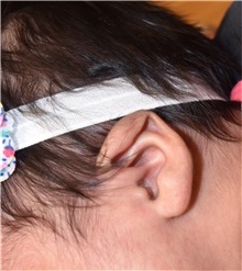 Ear Surgery Before Photo by Rachel Ruotolo, MD; Garden City, NY - Case 30305