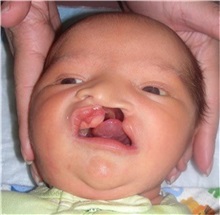 Cleft Lip and Palate Repair Before Photo by Rachel Ruotolo, MD; Garden City, NY - Case 34074