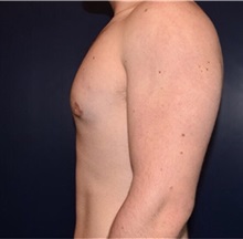 Male Breast Reduction After Photo by Rachel Ruotolo, MD; Garden City, NY - Case 34075