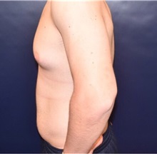 Male Breast Reduction Before Photo by Rachel Ruotolo, MD; Garden City, NY - Case 34075
