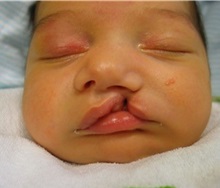 Cleft Lip and Palate Repair Before Photo by Rachel Ruotolo, MD; Garden City, NY - Case 34082