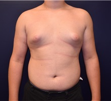 Male Breast Reduction Before Photo by Rachel Ruotolo, MD; Garden City, NY - Case 34088