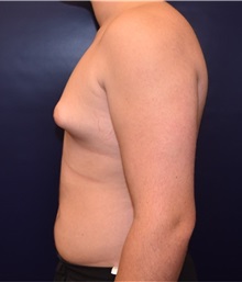 Male Breast Reduction Before Photo by Rachel Ruotolo, MD; Garden City, NY - Case 34088