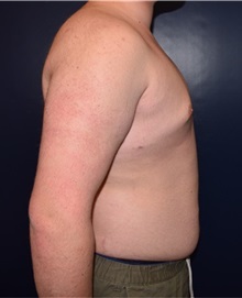 Male Breast Reduction After Photo by Rachel Ruotolo, MD; Garden City, NY - Case 34088