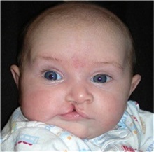 Cleft Lip and Palate Repair Before Photo by Rachel Ruotolo, MD; Garden City, NY - Case 34094