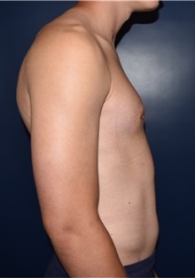 Male Breast Reduction After Photo by Rachel Ruotolo, MD; Garden City, NY - Case 34095