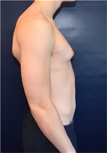 Male Breast Reduction Before Photo by Rachel Ruotolo, MD; Garden City, NY - Case 34095