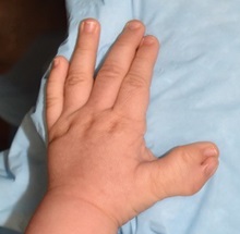 Hand Surgery for Congenital Differences Before Photo by Rachel Ruotolo, MD; Garden City, NY - Case 34198