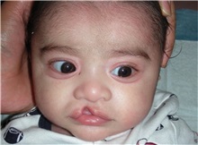 Cleft Lip and Palate Repair Before Photo by Rachel Ruotolo, MD; Garden City, NY - Case 34201