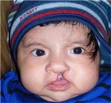 Cleft Lip and Palate Repair Before Photo by Rachel Ruotolo, MD; Garden City, NY - Case 34203