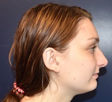 Ear Surgery After Photo by Rachel Ruotolo, MD; Garden City, NY - Case 34204