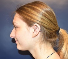 Ear Surgery Before Photo by Rachel Ruotolo, MD; Garden City, NY - Case 34204