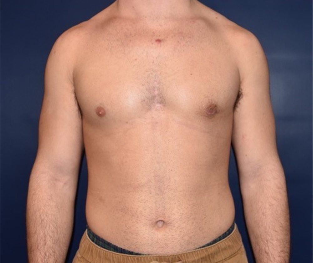 Male Breast Reduction Before and After Photos by Rachel Ruotolo, MD; Garden City, NY - Case 34209 | ASPS