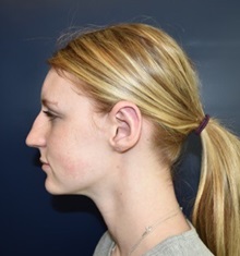 Ear Surgery After Photo by Rachel Ruotolo, MD; Garden City, NY - Case 34213
