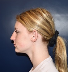 Ear Surgery Before Photo by Rachel Ruotolo, MD; Garden City, NY - Case 34213