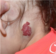 Vascular Malformations Before Photo by Rachel Ruotolo, MD; Garden City, NY - Case 34217