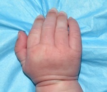 Hand Surgery for Congenital Differences After Photo by Rachel Ruotolo, MD; Garden City, NY - Case 34810