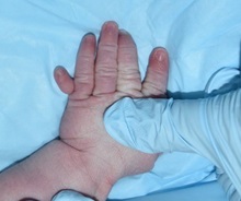 Hand Surgery for Congenital Differences Before Photo by Rachel Ruotolo, MD; Garden City, NY - Case 34810